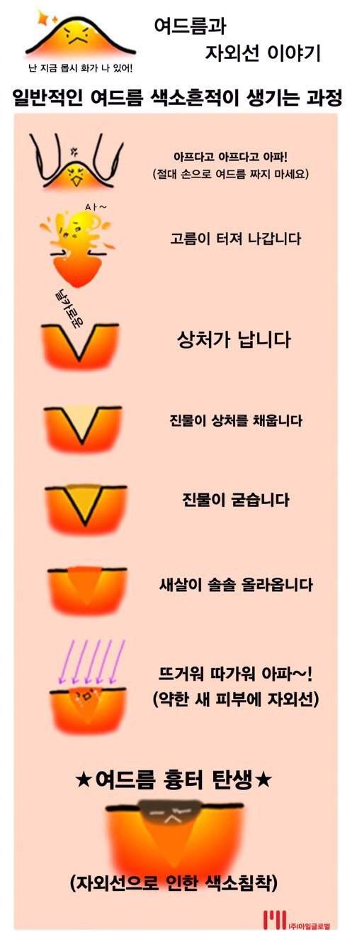 여드름을 짜면 안되는 이유.jpg | 인스티즈