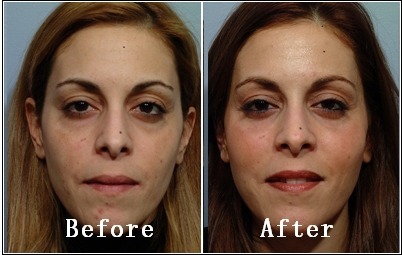 미국에서 많이하는 성형수술 세가지 | 인스티즈