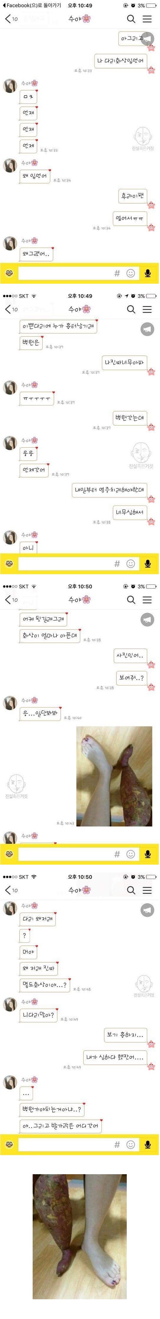 남자친구한테 화상입었다고 거짓말을 해봤다 | 인스티즈