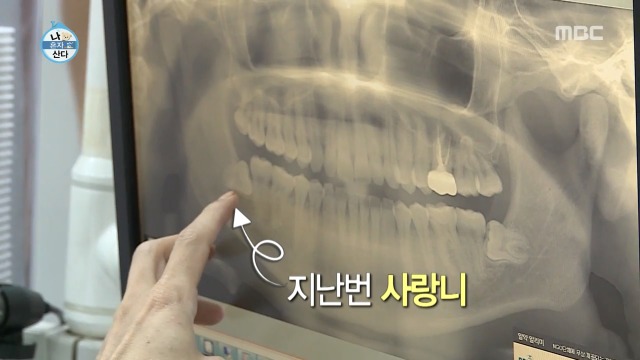 [나혼자산다] 너도나도 공감하는 공포의 사랑니 빼기 | 인스티즈