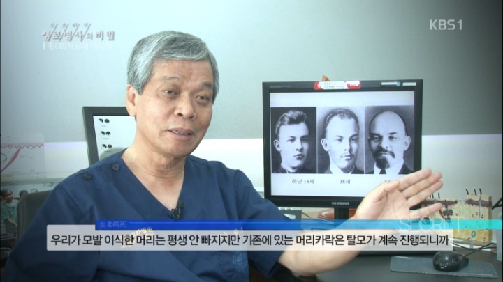 모발이식수술의 이면 | 인스티즈